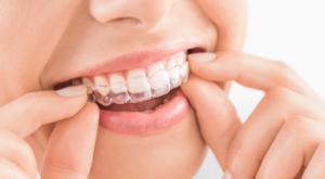 Invisalign® in Pell City, AL